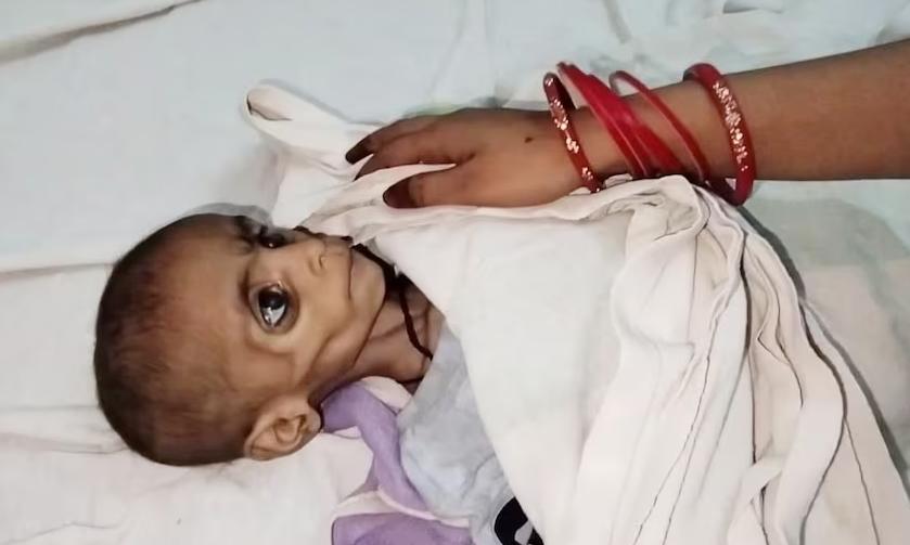 कुपोषित बच्चों